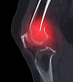 Fractured knee, CT scan