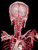 Head and shoulders, CT scan