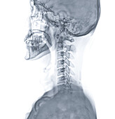 Head and neck bones, X-ray