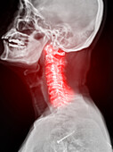 Neck pain, conceptual X-ray