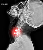 Pinned neck, X-ray