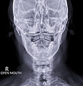Upper neck bones, X-ray