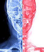 Upper neck bones, X-ray