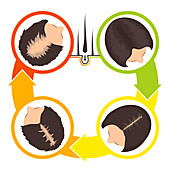 Hair transplantation, conceptual illustration