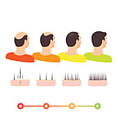 Hair transplantation, illustration