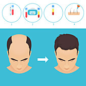 PRP hair loss treatment, illustration