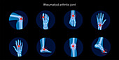 Rheumatoid arthritis, conceptual illustration