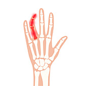 Broken finger, conceptual illustration
