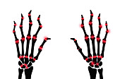 Arthritic hands, conceptual illustration