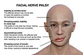 Facial palsy, illustration