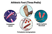 Athlete's foot, illustration