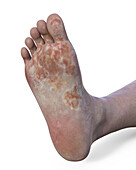 Fungal foot infection, illustration