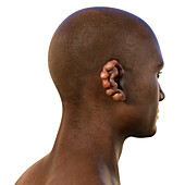 Ear lobomycosis nodules, illustration