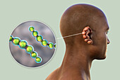 Lobomycosis fungal infection, illustration