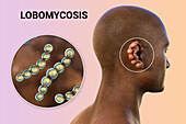 Lobomycosis fungal infection, illustration