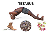 Tetanus, illustration