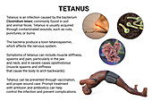 Tetanus, illustration