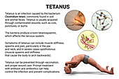 Tetanus, illustration