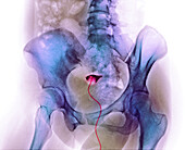 Blocked fallopian tube, X-ray