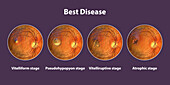 Stages of Best vitelliform macular dystrophy, illustration