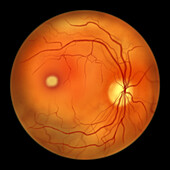 Best vitelliform macular dystrophy, illustration