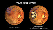 Retinal scar and healthy retina, illustration