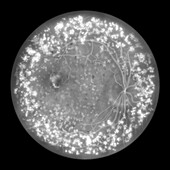 Autosomal dominant vitreoretinochoroidopathy, illustration