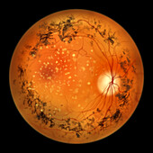 Retinitis pigmentosa, illustration