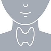Enlarged thyroid gland, illustration
