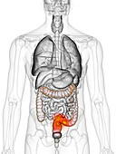 Bowel cancer, illustration