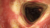 Crohn's disease in colon, illustration