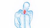 Neck pain, illustration