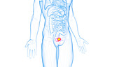 Bladder cancer, illustration