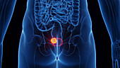 Urinary bladder cancer, illustration