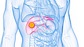 Liver cancer, illustration