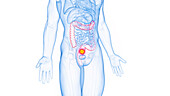 Rectal cancer, illustration