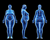 Obese female body, illustration