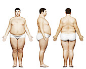 Obese male body, illustration