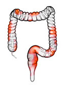 Colon inflammation, illustration