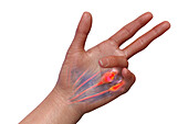 Dupuytren's contracture, illustration