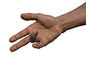 Dupuytren's contracture, illustration