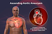 Ascending aortic aneurysm, illustration