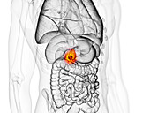 Gallbladder cancer, illustration