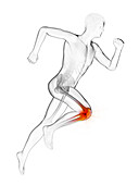 Runner's painful knee, illustration