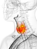 Thyroid cancer, illustration