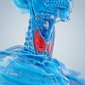 Inflamed thyroid gland, illustration