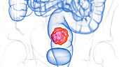 Colon tumour, illustration