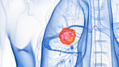 Lung tumour, illustration