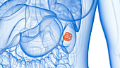 Spleen tumour, illustration