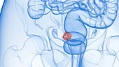 Uterus tumour, illustration